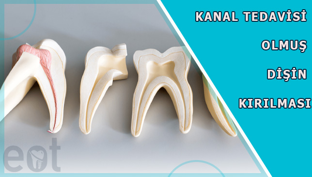 kanalli-dis-kirilmasi