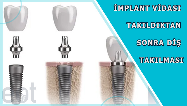 implant-vidasi