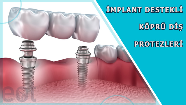 implant-destekli-kopru