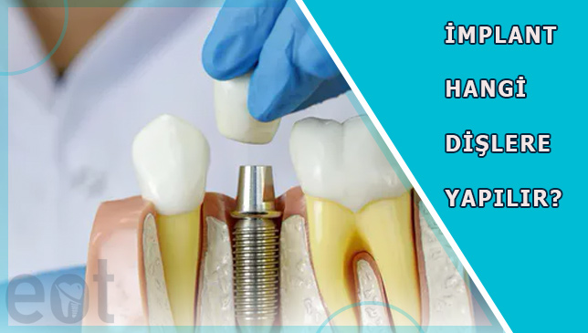 implant-hangi-dislere-yapilir