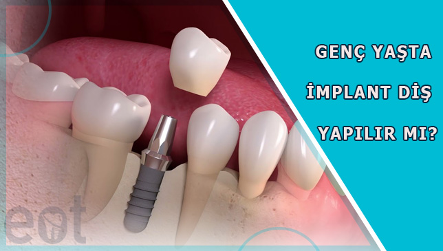 genc-yasta-implant-dis