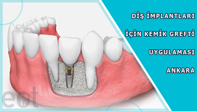 kemik-grefti-implant