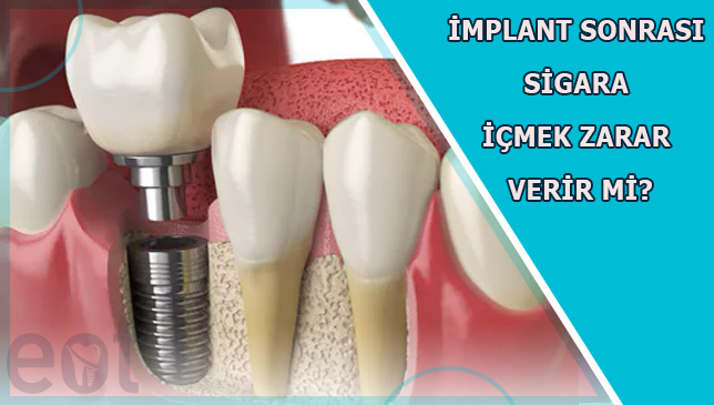 implant-sonrasi-sigara