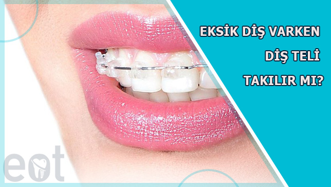 Eksik-Dis-Varken-Dis-Teli