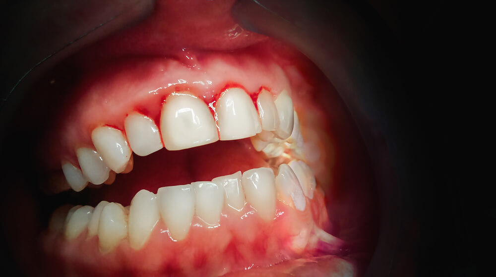 Periodontal Hastalıkları